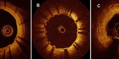 Exemples d'analyses OCT de stents à 6 mois :
A : couverture fin et homogène des mailles du stents
B : insuffissance de couverture avec des mailles restant à nues dans la lumière du vaisseau : aspect "crenelé"
C : espect OCT de resténose. La couverture endothéliale est trop importante, réduisant la lumière résiduelle.