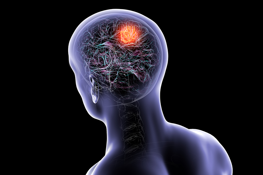 Le fonds Aliénor soutient le docteur Pierre-Olivier Guichet et la recherche sur le glioblastome